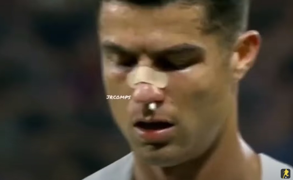 Ronaldo bê bết máu vì bị chấn thương